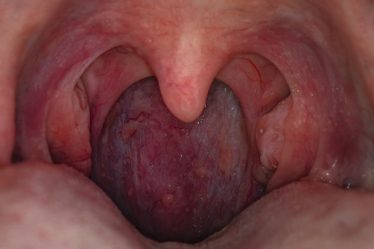 Êtes-vous plus susceptible d'avoir des infections pulmonaires si vous n'avez pas d'amygdales ? - 7