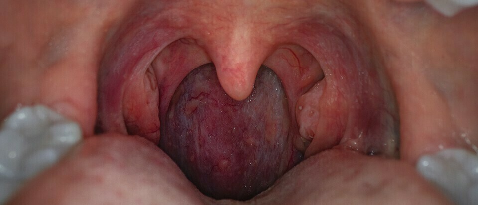 Êtes-vous plus susceptible d'avoir des infections pulmonaires si vous n'avez pas d'amygdales ? 2 Êtes-vous plus susceptible d'avoir des infections pulmonaires si vous n'avez pas d'amygdales ? - 1
