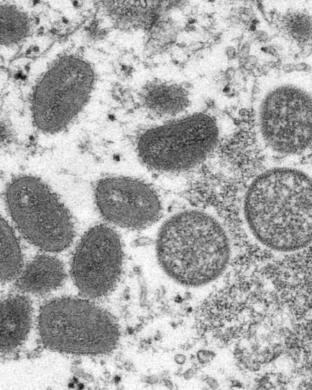 Explication du Monkeypox : pourquoi il se propage, quelles en sont les causes et les symptômes 20 Explication du Monkeypox : pourquoi il se propage, quelles en sont les causes et les symptômes - 19