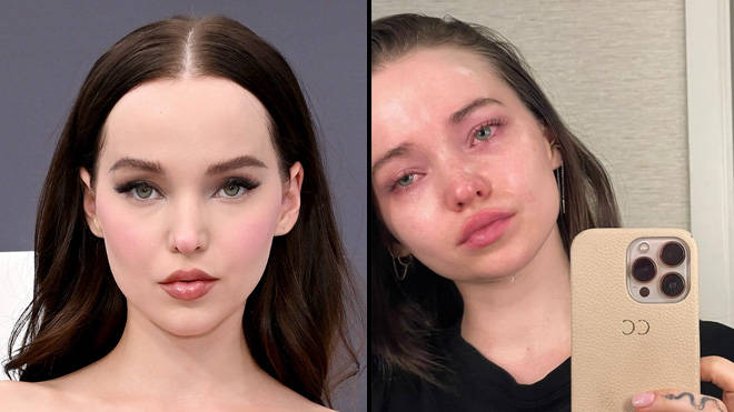 Dove Cameron parle de sa lutte contre la dépression et la dysphorie