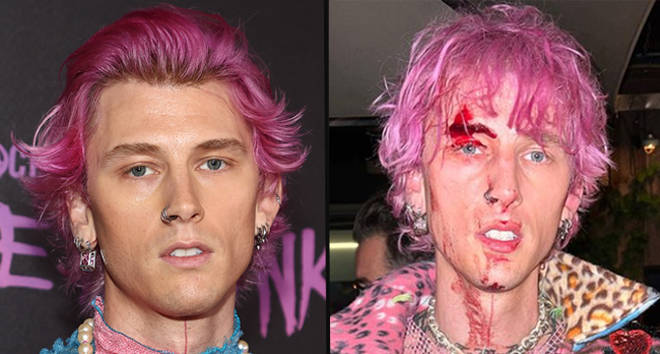 Machine Gun Kelly est parti couvert de sang après avoir brisé une coupe de champagne au visage 3 Machine Gun Kelly révèle pourquoi il s'est cassé une coupe de champagne au visage