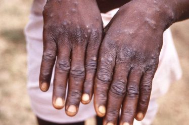 Monkeypox déclaré urgence mondiale par l'Organisation mondiale de la santé - 5