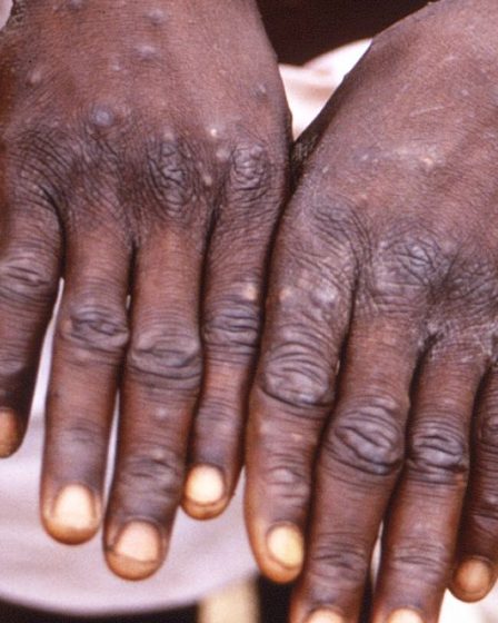 Monkeypox déclaré urgence mondiale par l'Organisation mondiale de la santé - 21