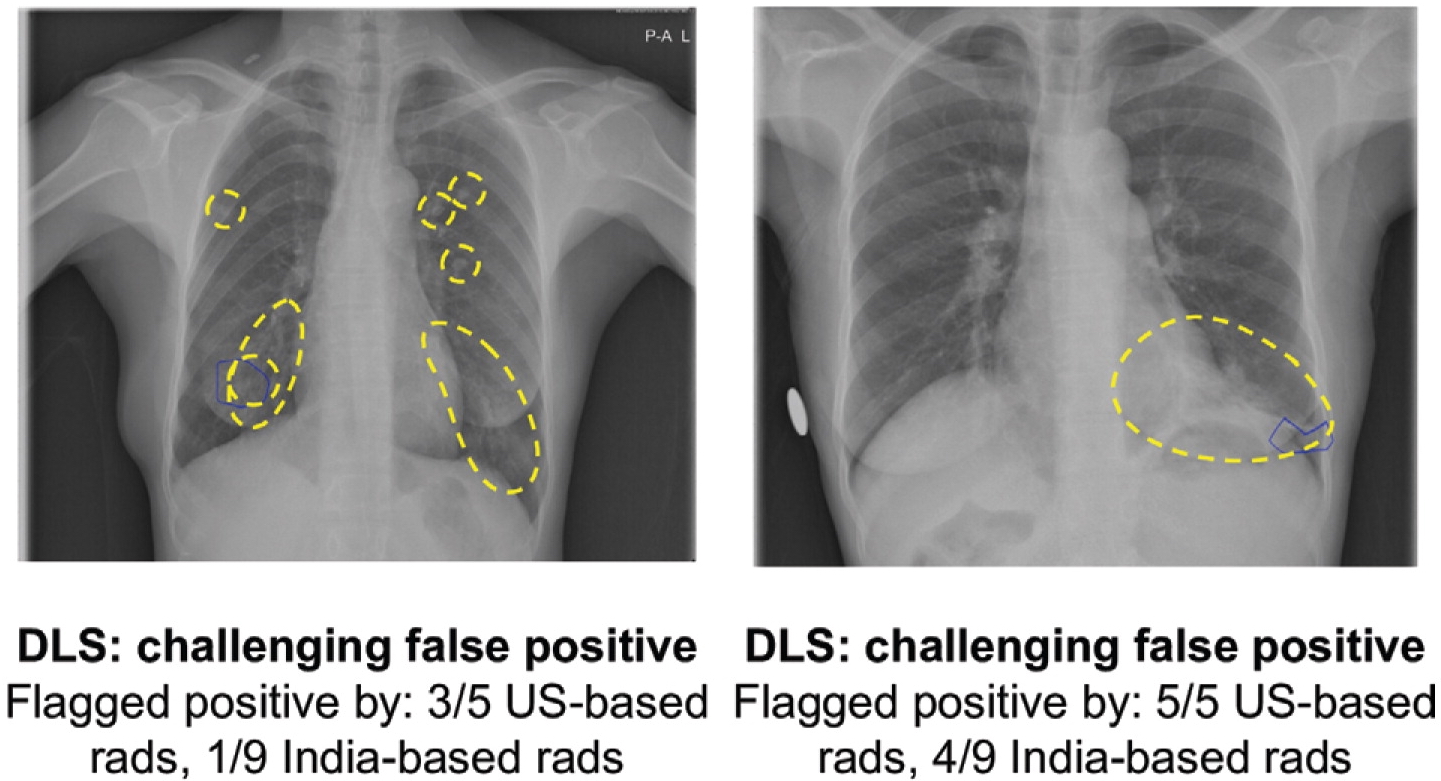 L'apprentissage en profondeur comme outil de dépistage de la tuberculose dans les régions à faible revenu › Geeky News - 5