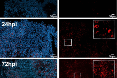 Une perte excessive de connexions neuronales peut expliquer des symptômes cognitifs persistants - 9