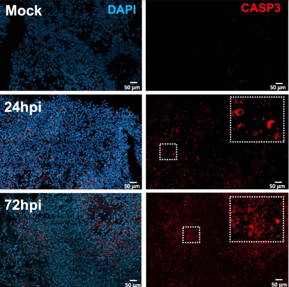 Une perte excessive de connexions neuronales peut expliquer des symptômes cognitifs persistants 2 Une perte excessive de connexions neuronales peut expliquer des symptômes cognitifs persistants - 1