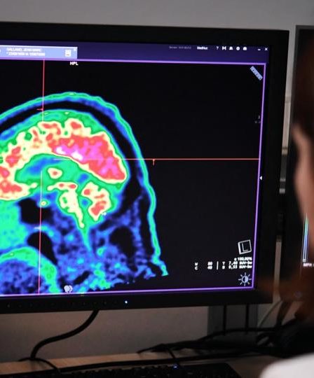 Trois fois plus de victimes d'AVC quittent l'hôpital sans conséquences graves grâce à l'intelligence artificielle 67 Trois fois plus de victimes d'AVC quittent l'hôpital sans conséquences graves grâce à l'intelligence artificielle - 66