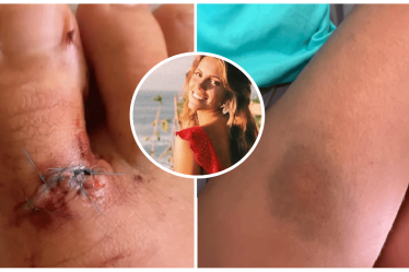 Bain de sang à The Pass, spot de surf australien sans foi ni loi, alors qu'une femme subit d'horribles blessures suite à une collision avec un surfeur "insincère". "C'est comme s'il n'y avait pas de règles là-bas parfois !". - BeachGrit - 9