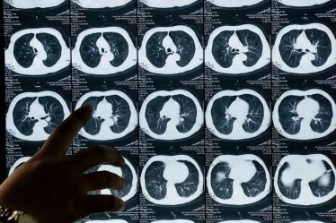Cancer du poumon : améliorer la survie en France - 5
