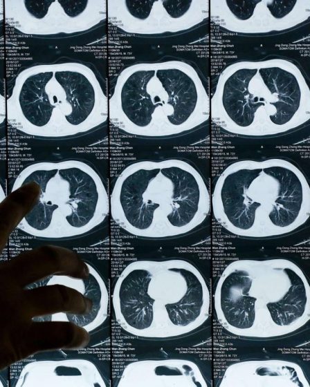 Cancer du poumon : améliorer la survie en France 6 Cancer du poumon : améliorer la survie en France - 5