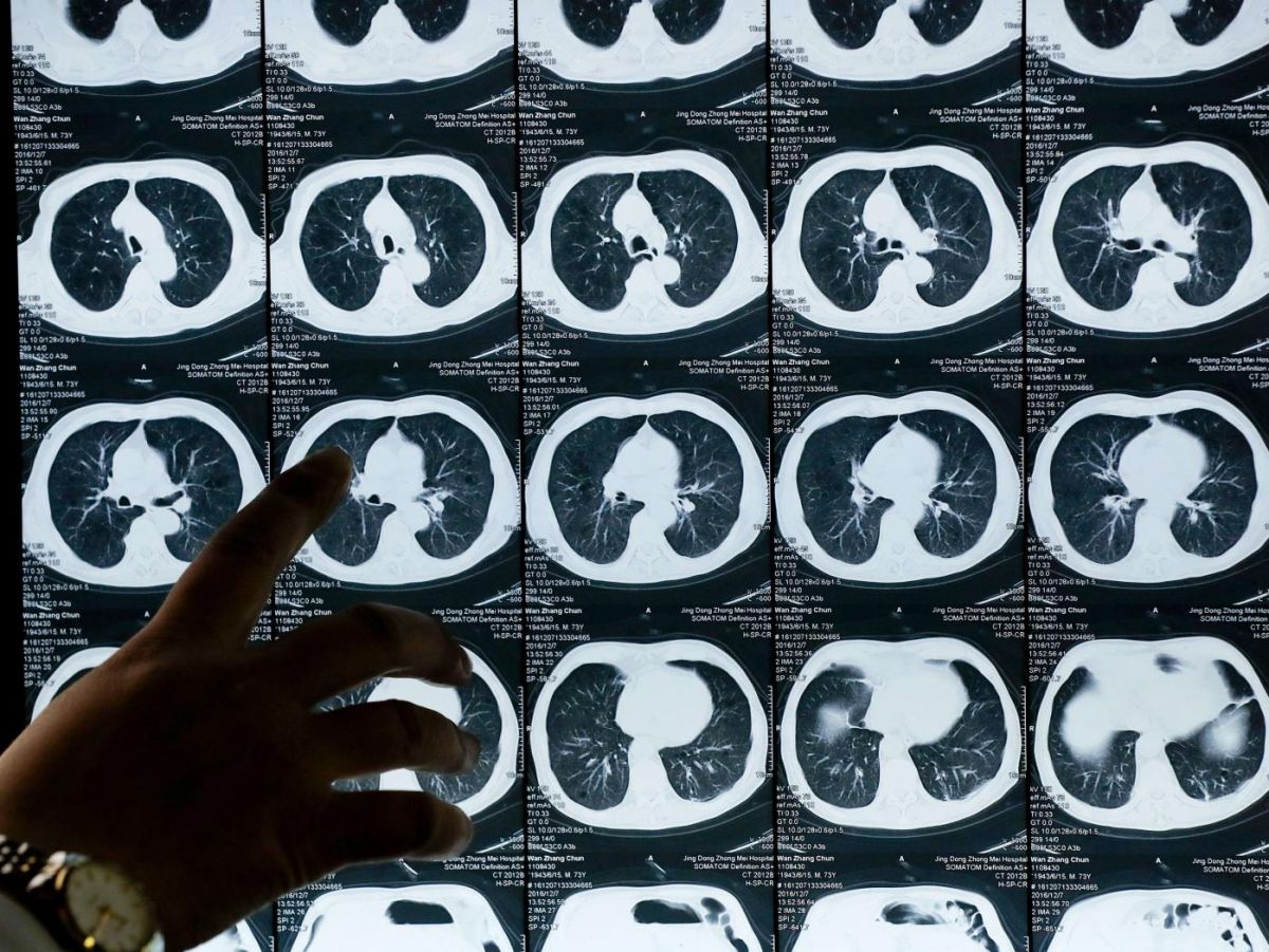 Cancer du poumon : améliorer la survie en France 2 Cancer du poumon : améliorer la survie en France - 1