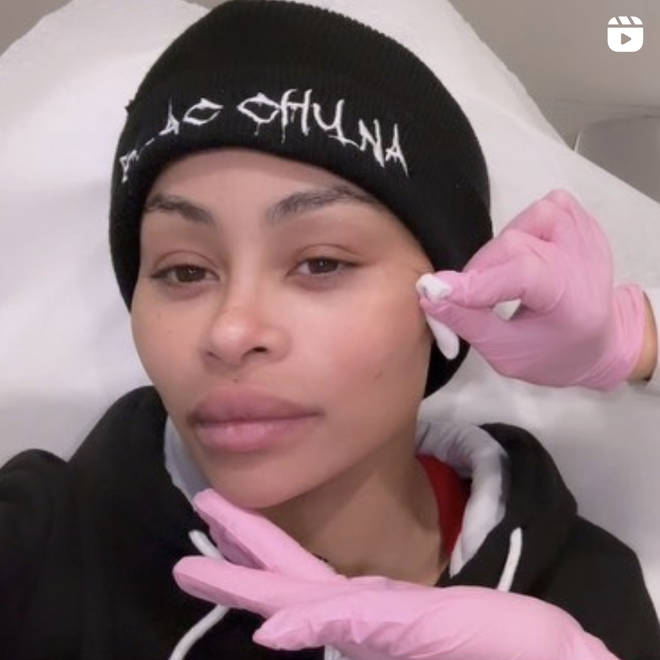 Blac Chyna publie une vidéo de transformation du visage après avoir dissous tous ses produits de remplissage 4 Blac Chyna l'a documentée