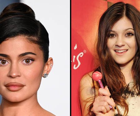 Kylie Jenner parle de la chirurgie plastique qu'elle a subie sur son visage 21 Kylie Jenner parle de la chirurgie plastique qu'elle a subie sur son visage - 20