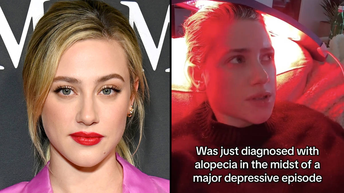 Lili Reinhart partage qu'on lui a diagnostiqué une alopécie 2 Lili Reinhart partage qu'on lui a diagnostiqué une alopécie - 1